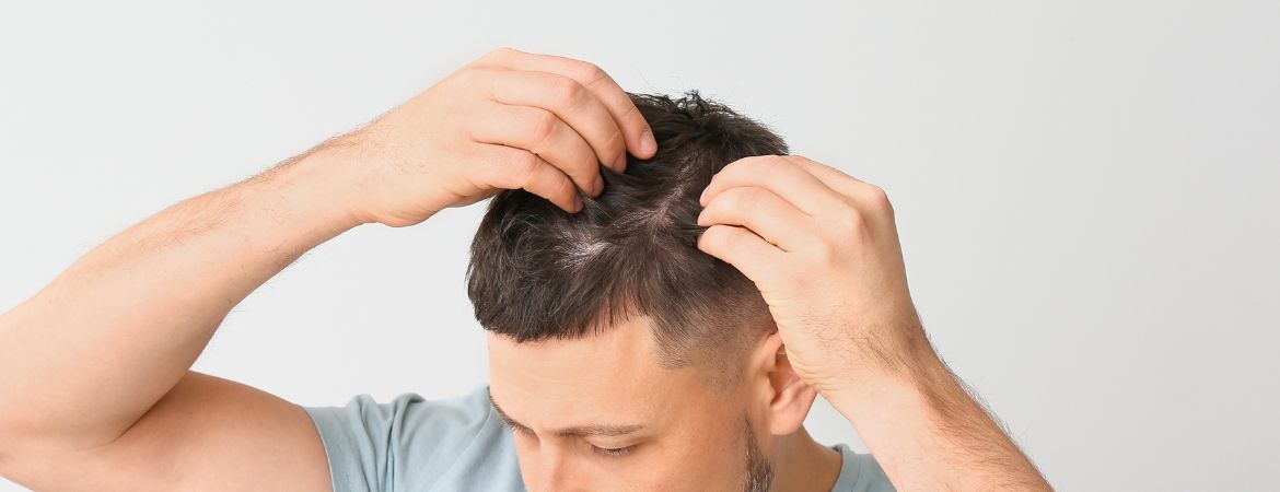 Hair Loss Solutions for Men: Treatments for Balding & Thinning Hair Lines