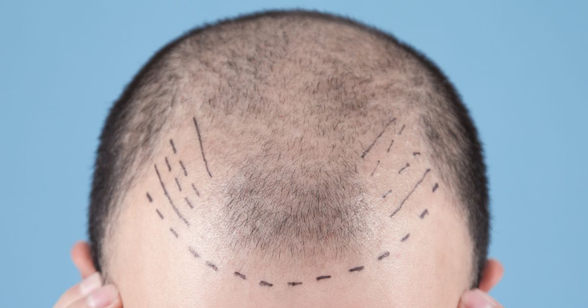 FUE Hair Transplant at Terra Medical Clinic